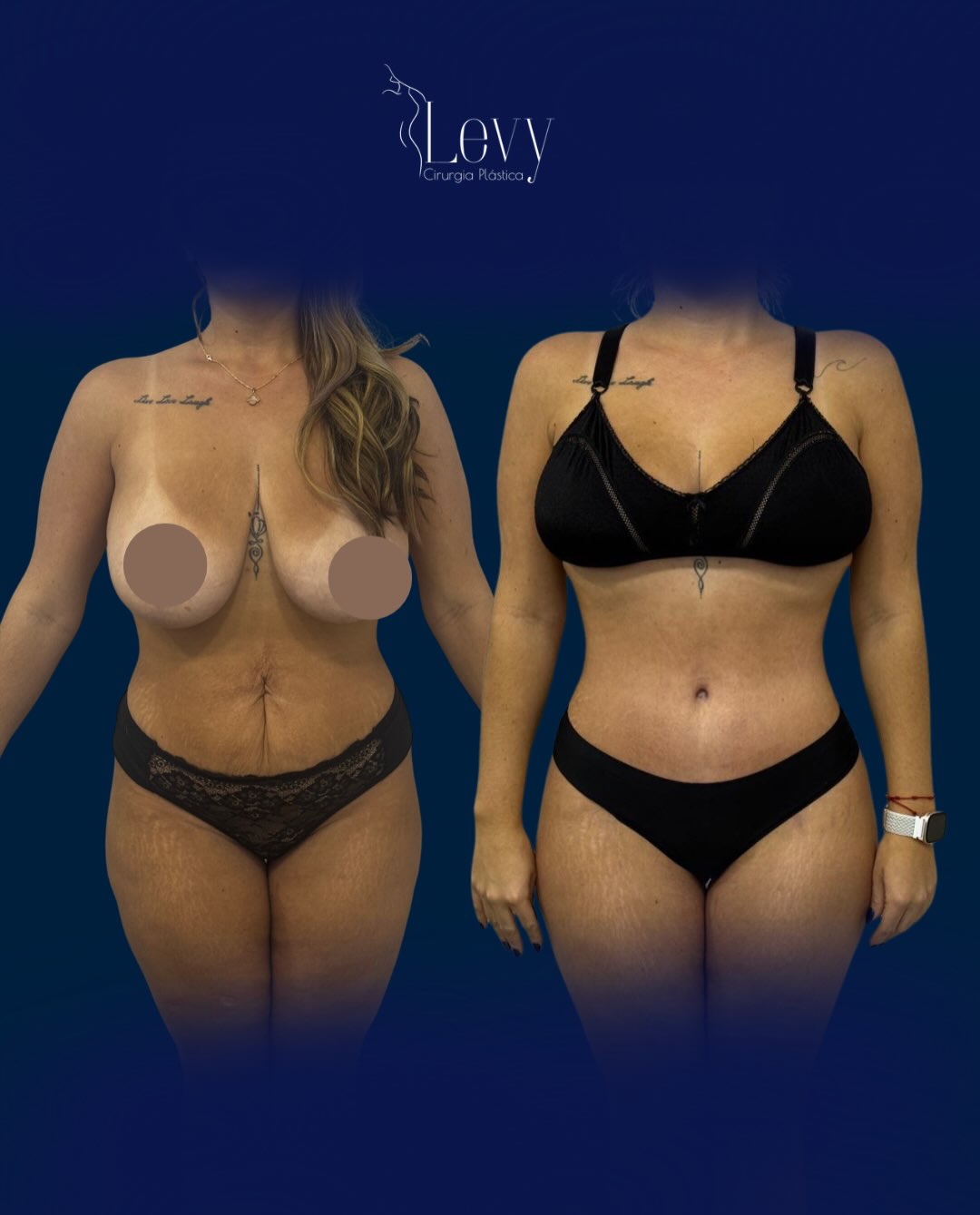 Lipoaspiração HD