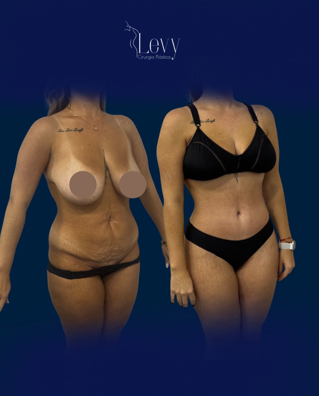 Abdominoplastia