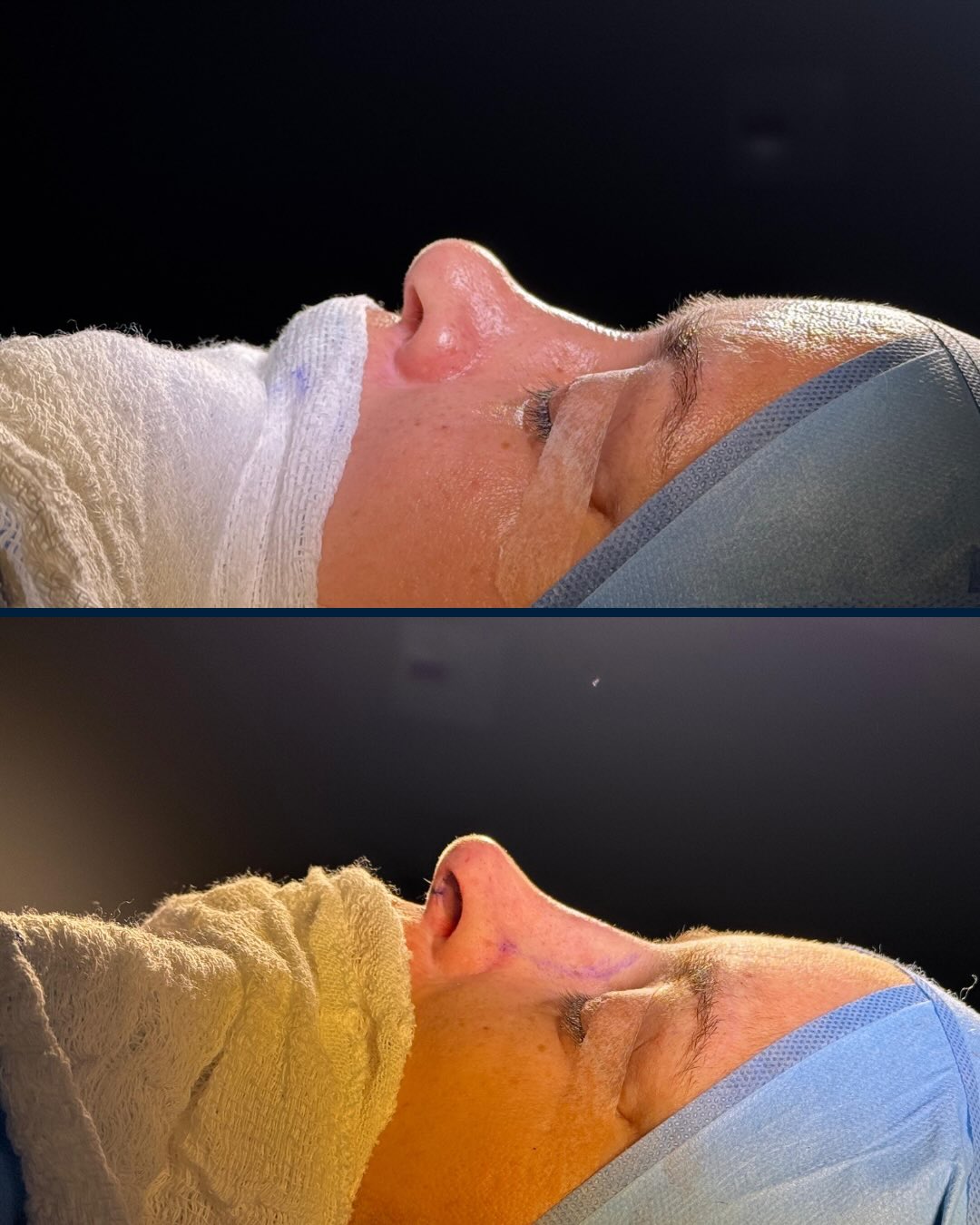 Rinoplastia